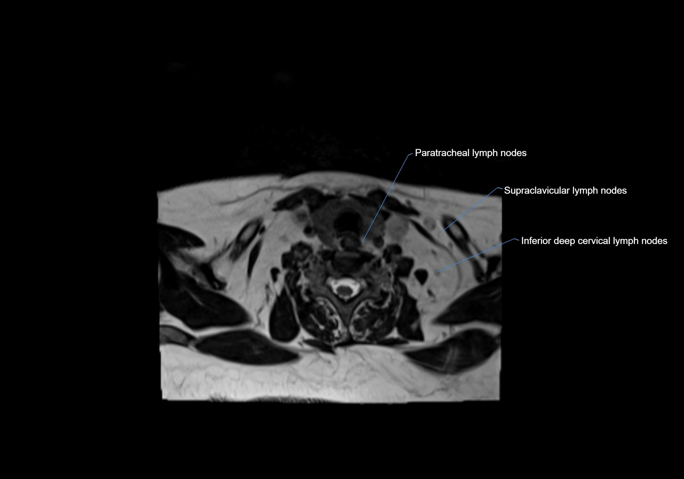 Neck axial  lymph node cross sectional MRI anatomy 3T MRI  image-img-00001-00080.webp